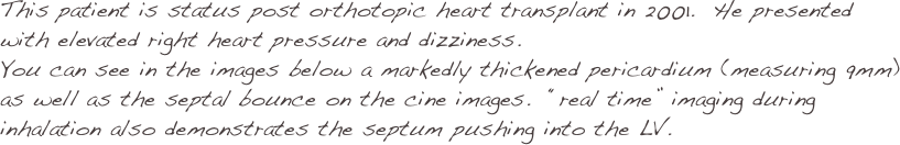 This patient is status post orthotopic heart transplant in 2001.  He presented with elevated right heart pressure and dizziness.  
You can see in the images below a markedly thickened pericardium (measuring 9mm) as well as the septal bounce on the cine images.  “real time” imaging during inhalation also demonstrates the septum pushing into the LV.