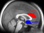 black and white brain image with red and blue overlays added